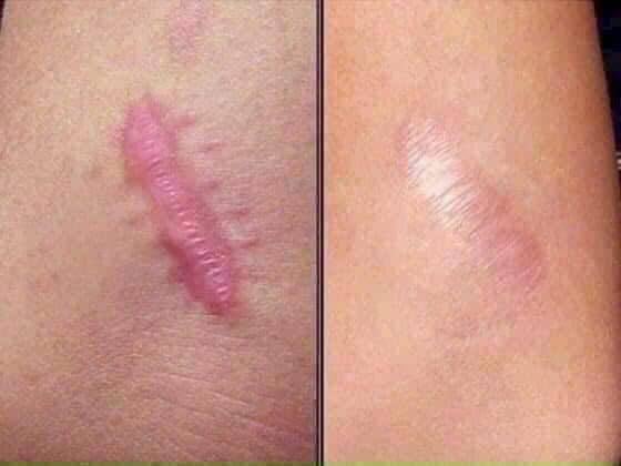 Side-by-side comparison of a raised pink scar on skin before and after treatment or healing